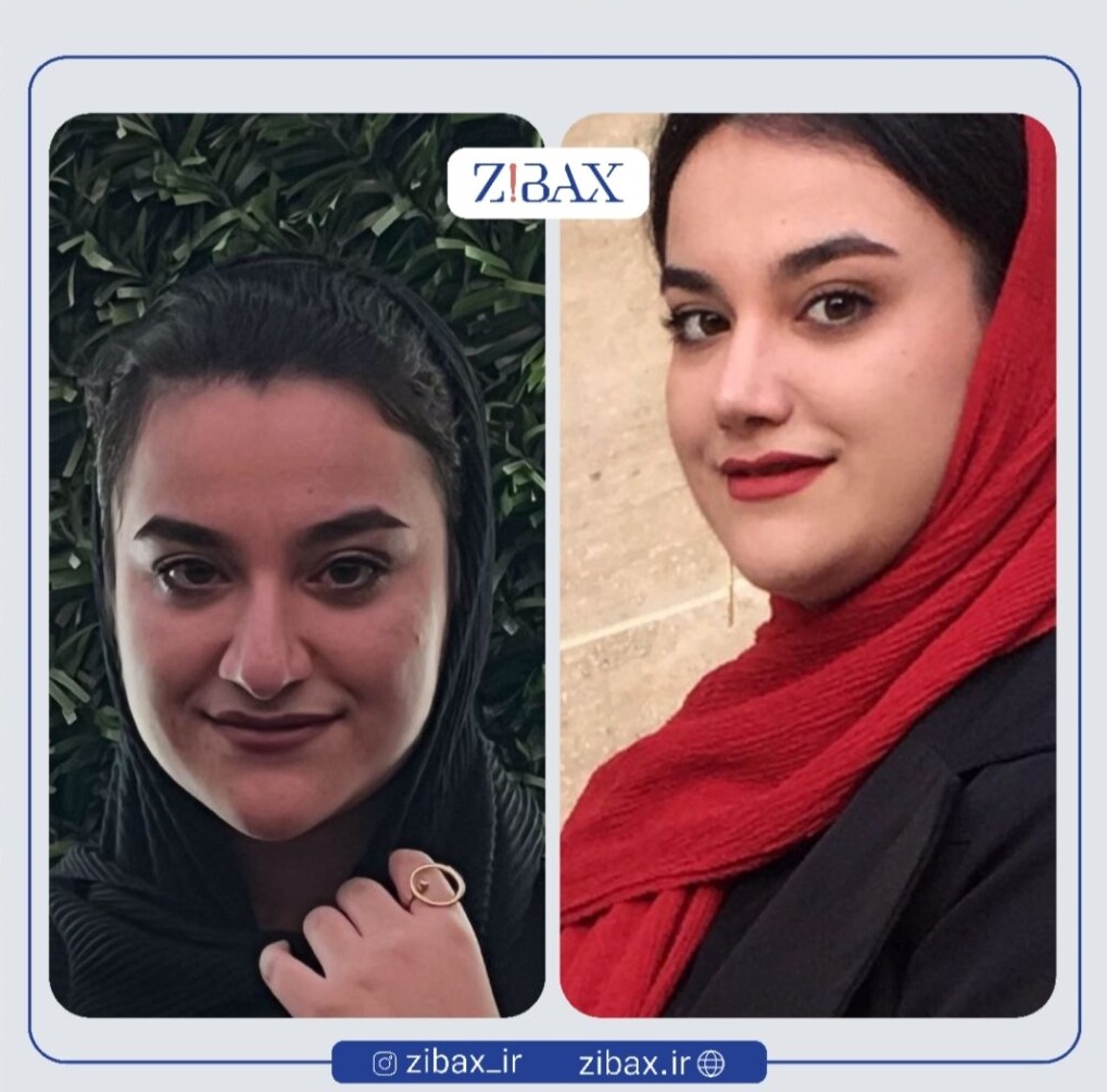 عکس مدل بینی طبیعی مدرن بعد از عمل بینی با زیباکس