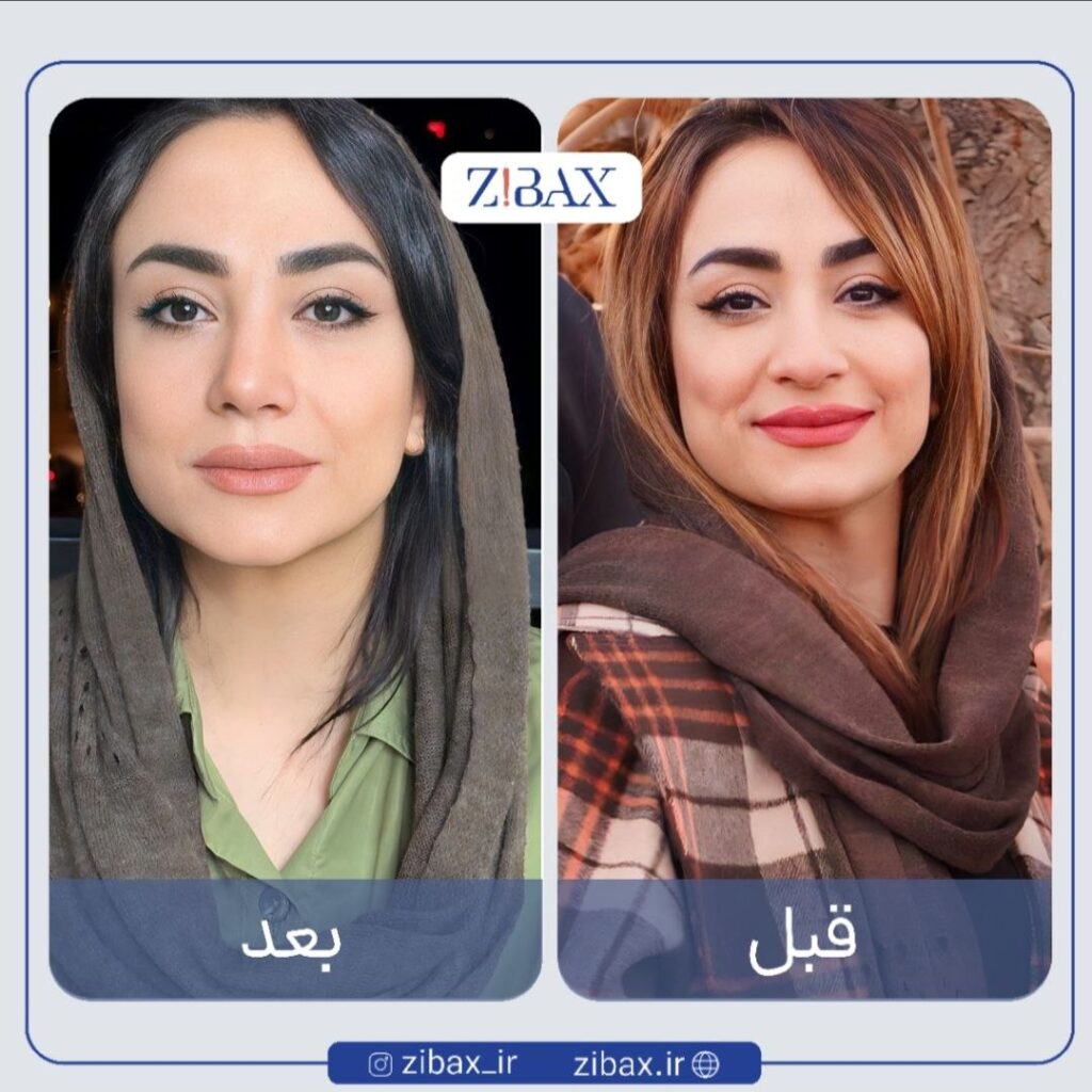 نمونه عمل بینی طبیعی در تهران با مشاوره زیباکس