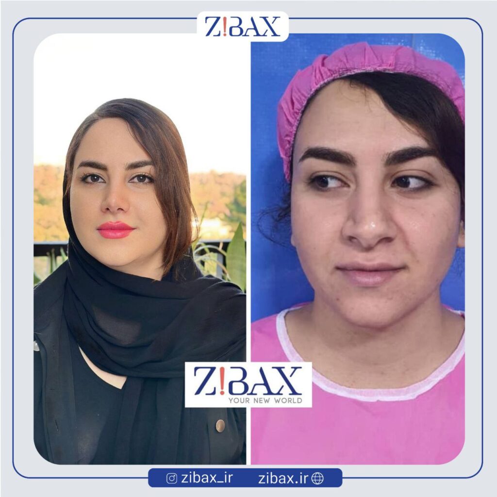 نمونه عمل بینی طبیعی در تهران با مشاوره زیباکس