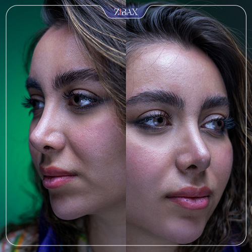 جراحی بینی نیمه فانتزی با زیباکس