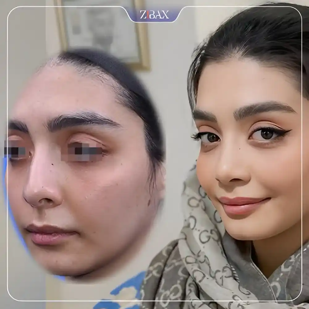 نمونه عمل جراحی بینی دکتر آرش شرفیان — تصویر 4