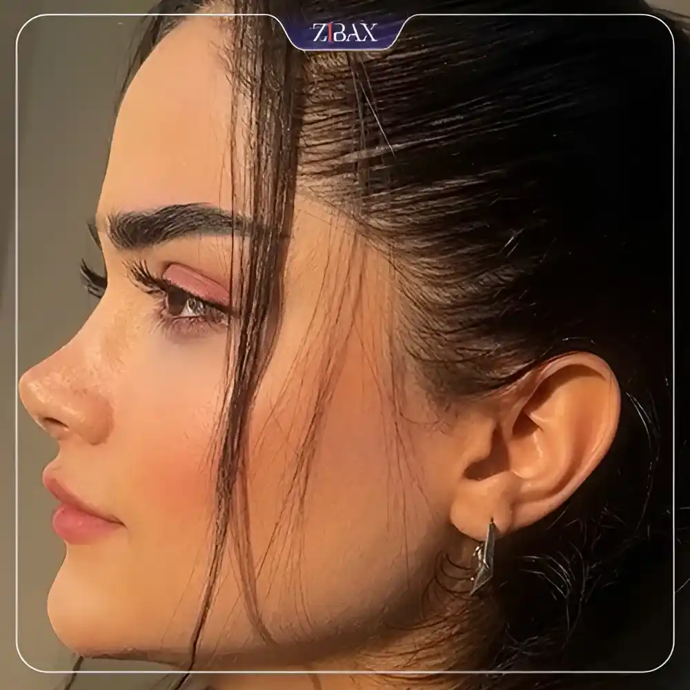 نمونه عمل جراحی بینی دکتر آرش شرفیان — تصویر 7