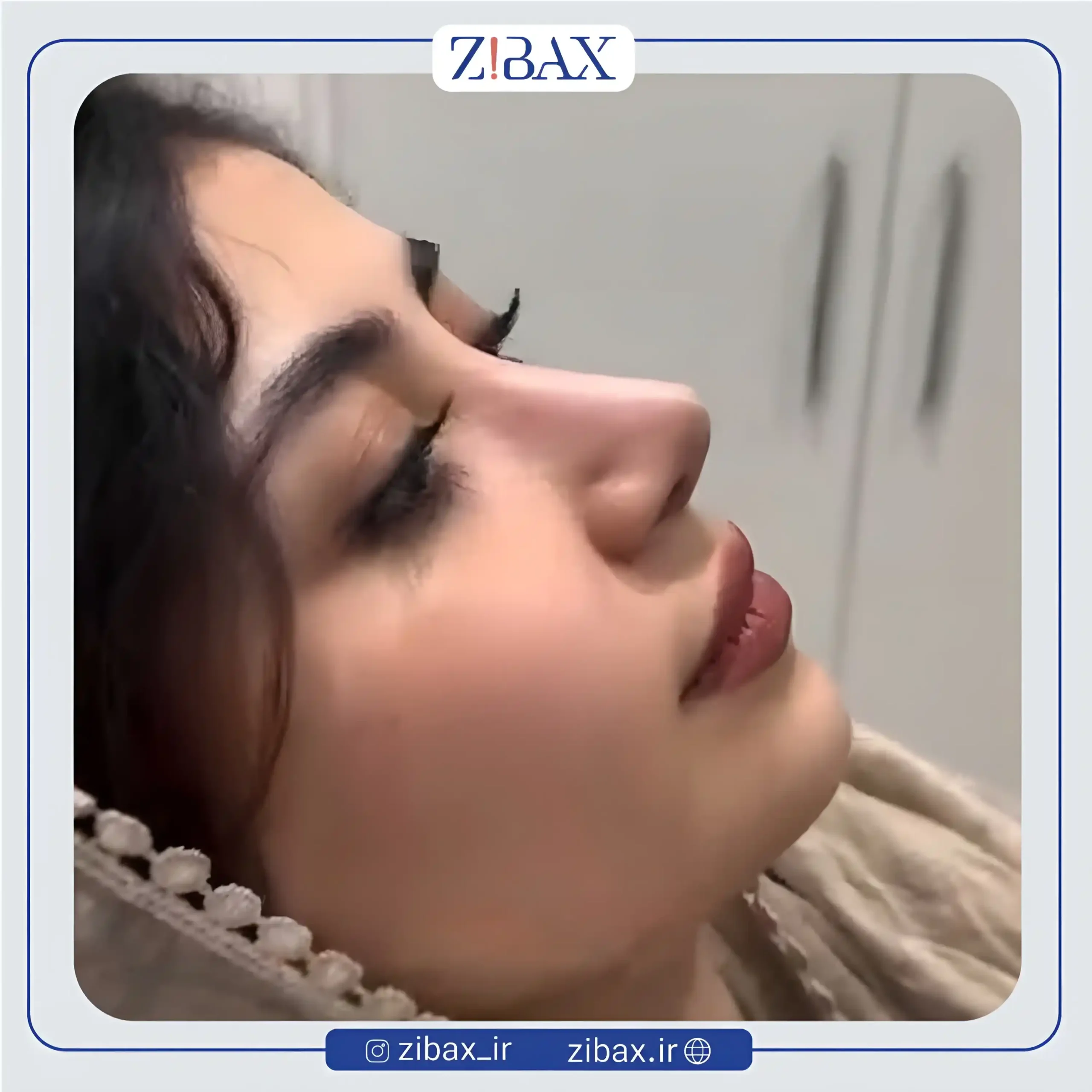 نمونه عمل جراحی بینی دکتر آرش شرفیان — تصویر 6