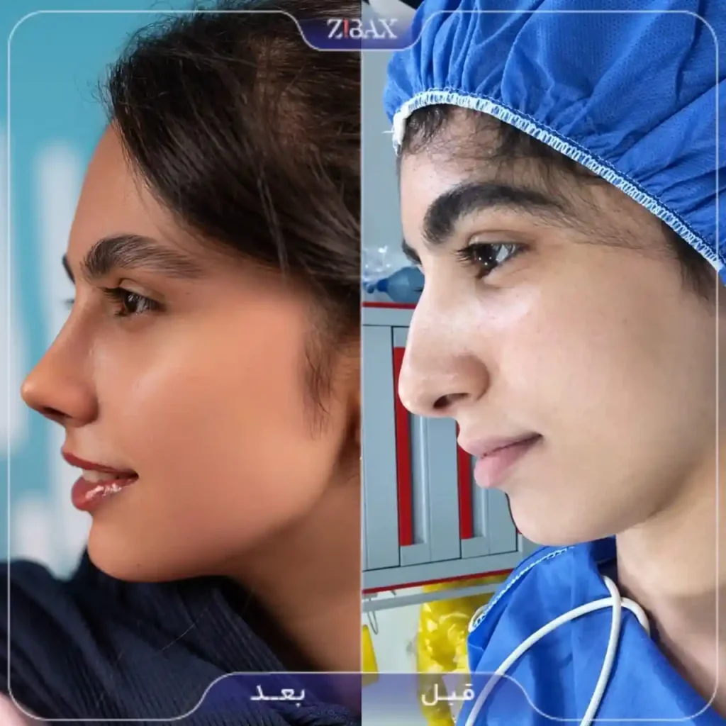 نمونه کار بینی طبیعی