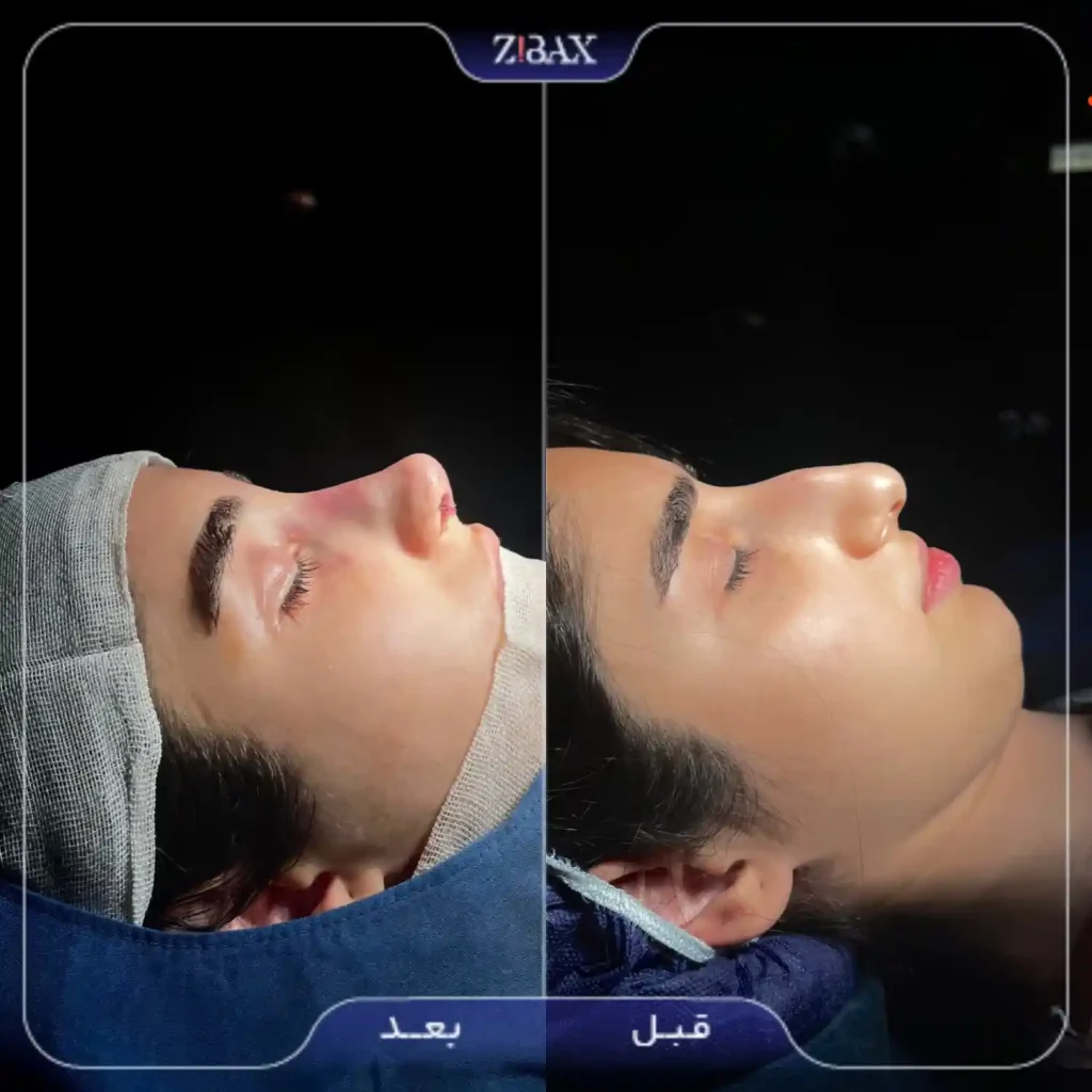 نمونه کار عمل بینی طبیعی
