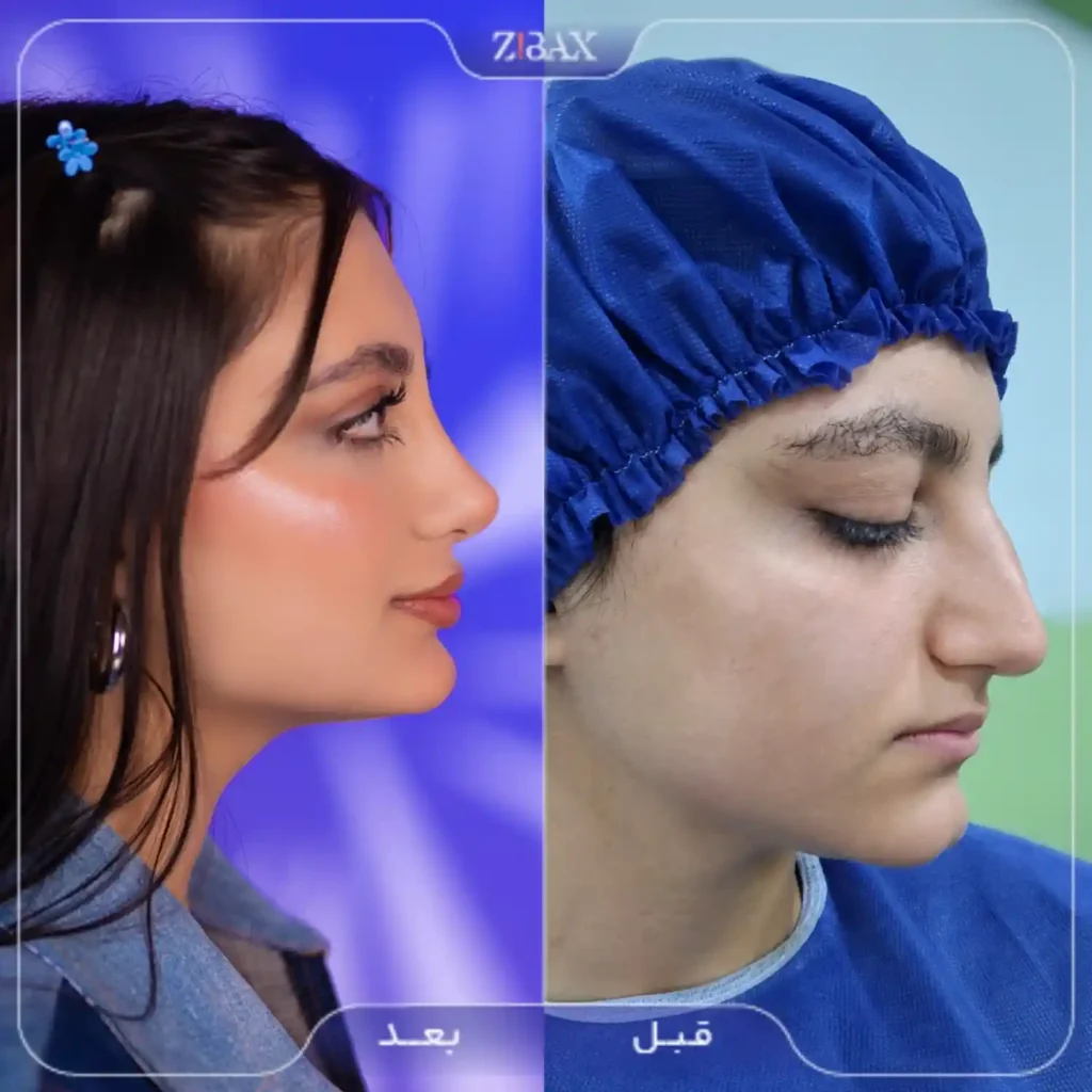 عکس قبل و بعد عمل بینی طبیعی