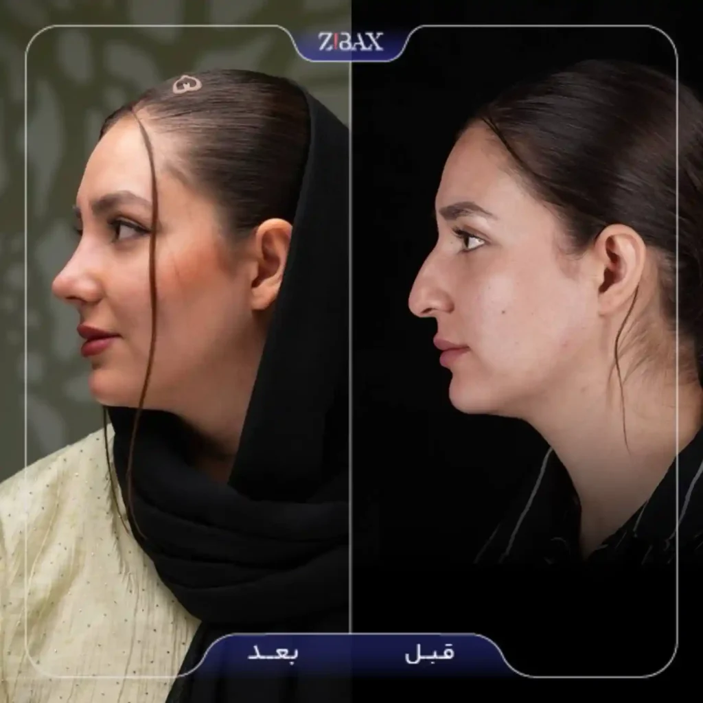 نمونه کار قبل و بعد عمل بینی طبیعی