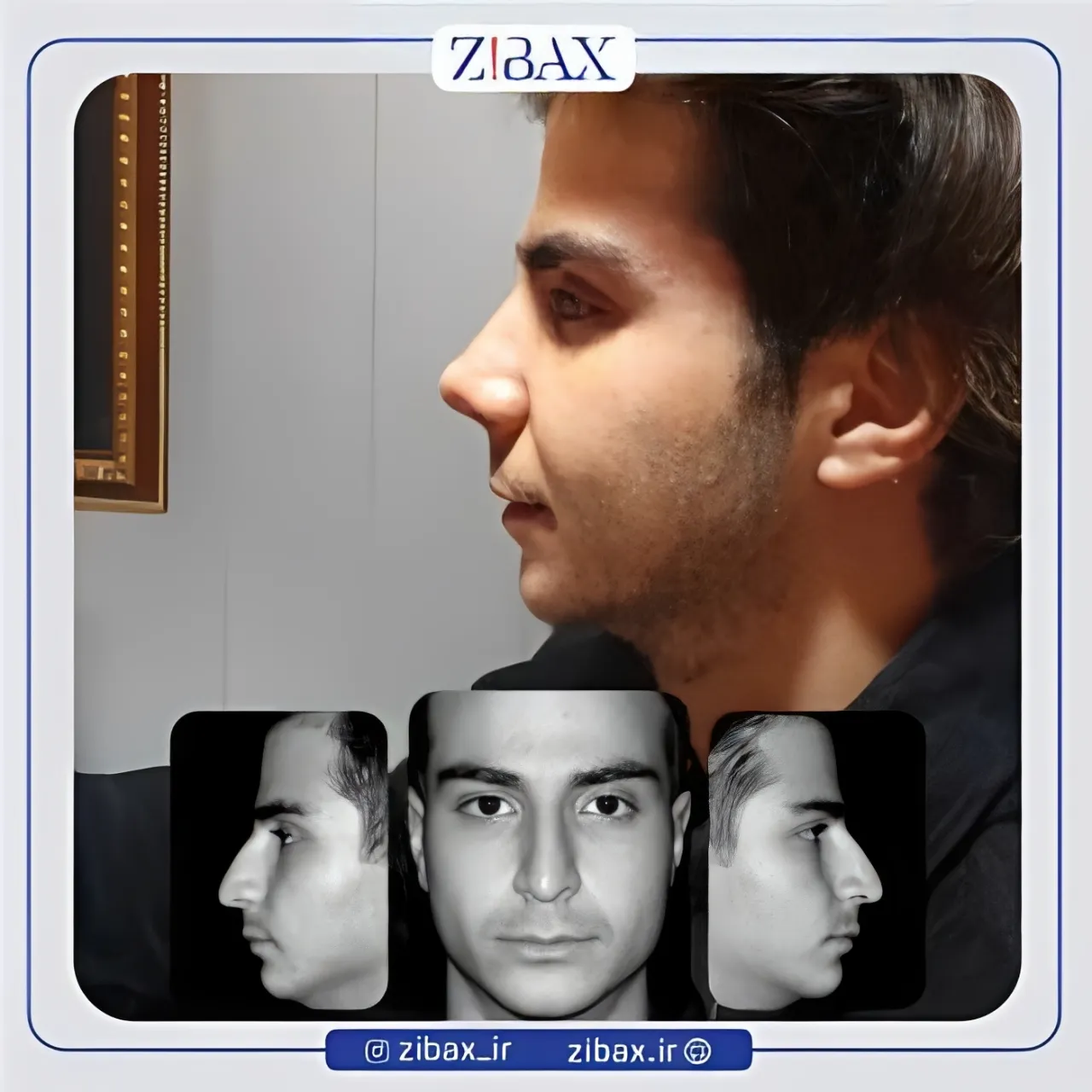 نمونه عمل جراحی بینی دکتر وحیده درتاج — تصویر 7