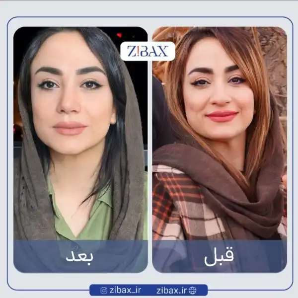 عکس قبل و بعد عمل بینی گوشتی طبیعی