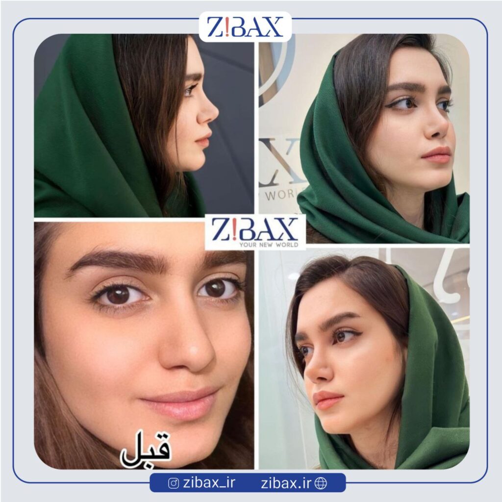 جراحی بینی نیمه فانتزی با مجموعه زیباکس