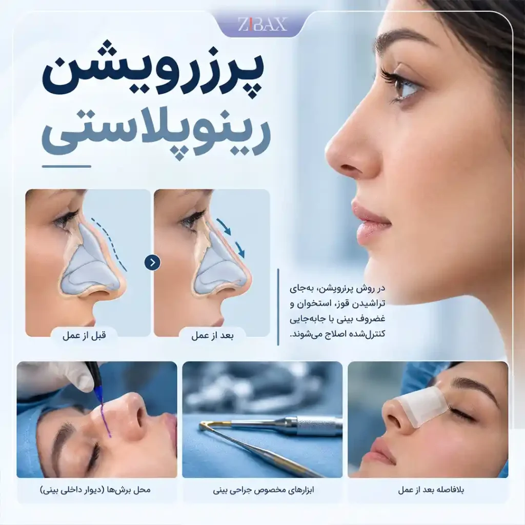 پرزرویشن رینوپلاستی