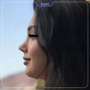 نمونه عمل جراحی بینی دکتر علیرضا دادگستر — تصویر 1