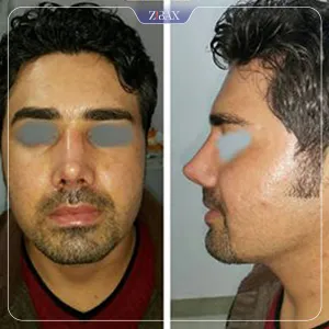 نمونه عمل جراحی بینی دکتر علیرضا دادگستر — تصویر 3