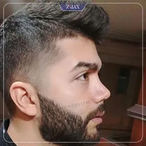 نمونه عمل جراحی بینی دکتر علیرضا دادگستر — تصویر 4