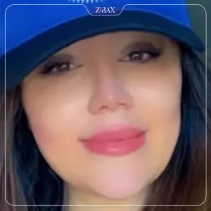 نمونه عمل جراحی بینی دکتر رضا وقر دوست — تصویر 7
