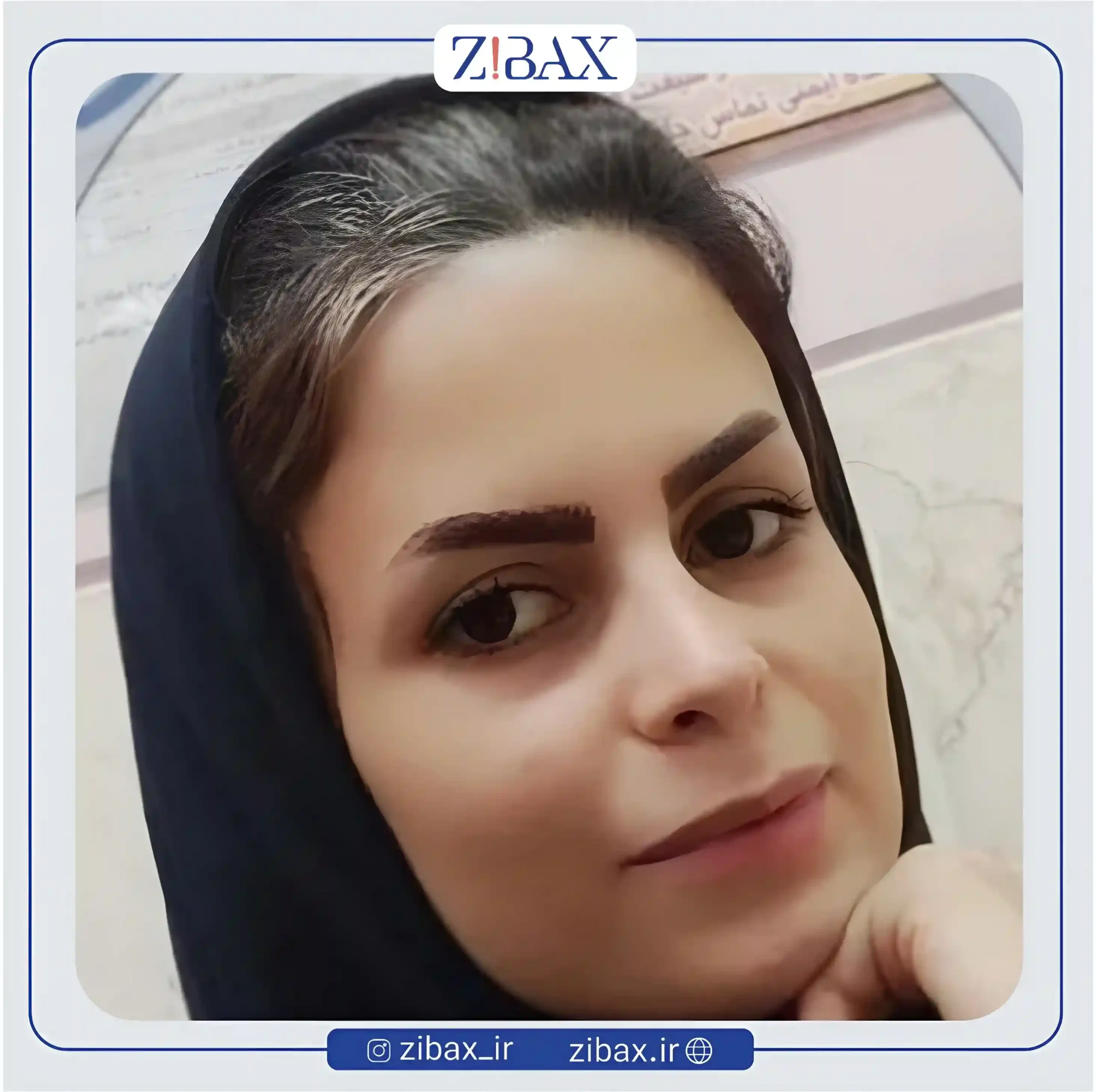 نمونه عمل جراحی بینی دکتر صالح محبی — تصویر 2