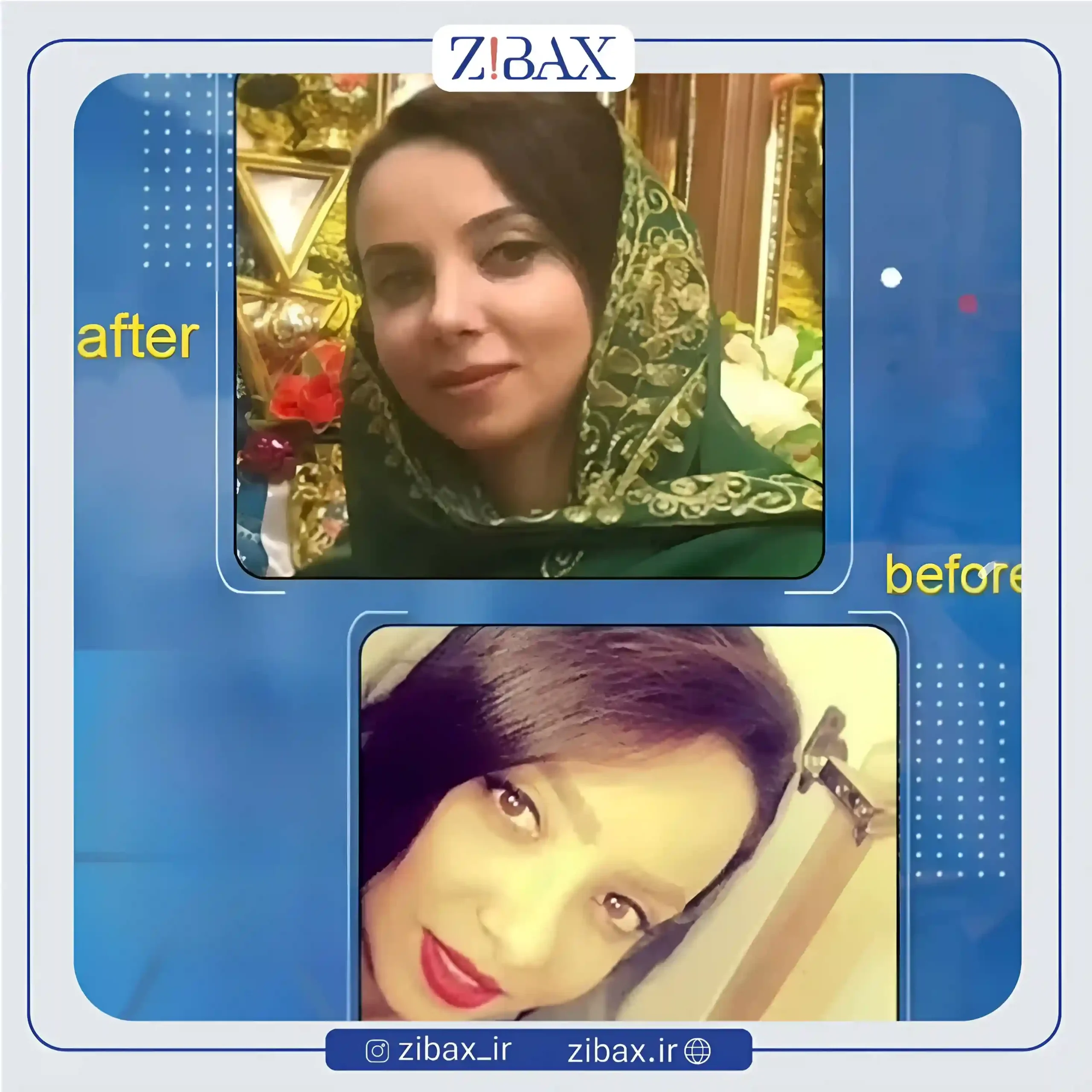 نمونه عمل جراحی بینی دکتر صالح محبی — تصویر 1