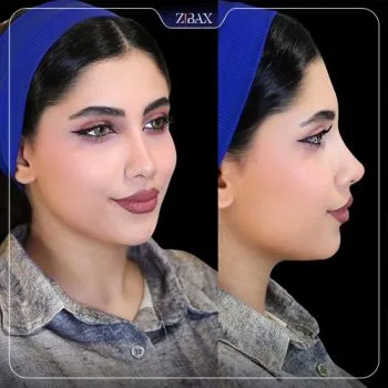 نمونه عمل جراحی بینی دکتر مریم بحری — تصویر 3