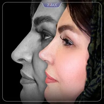 نمونه عمل جراحی بینی دکتر مریم بحری — تصویر 1