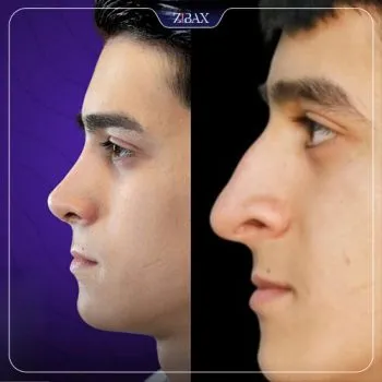 نمونه عمل جراحی بینی دکتر مریم بحری — تصویر 9