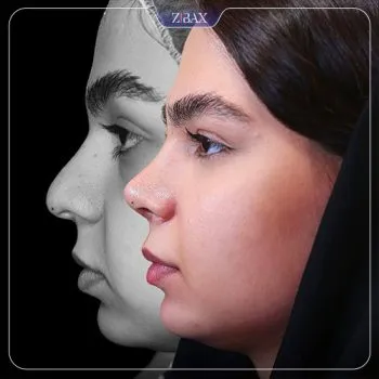 نمونه عمل جراحی بینی دکتر مریم بحری — تصویر 8