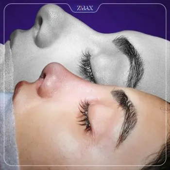 نمونه عمل جراحی بینی دکتر مریم بحری — تصویر 7