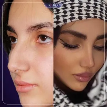 نمونه عمل جراحی بینی دکتر مریم بحری — تصویر 2