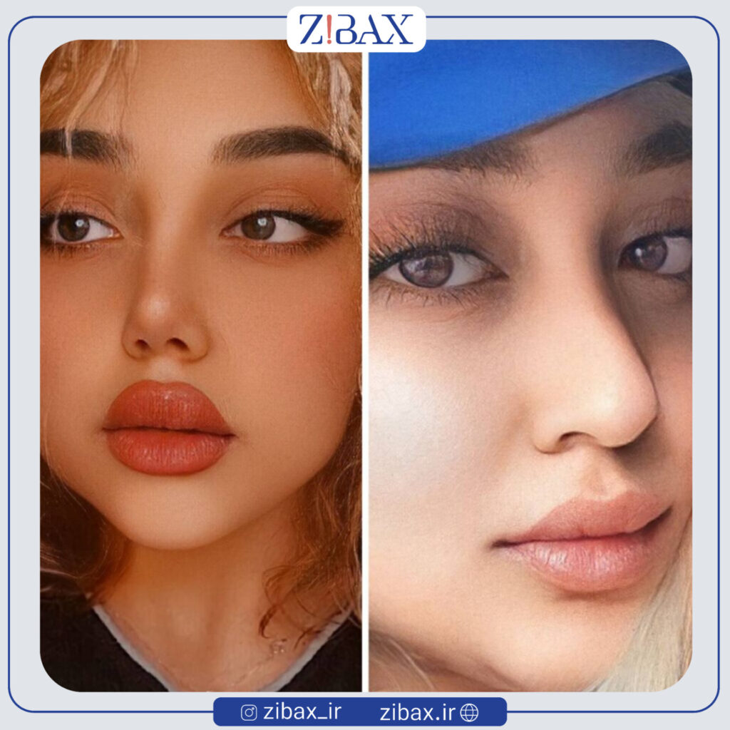 نمونه جراحی بینی فانتزی با مشاوره زیباکس