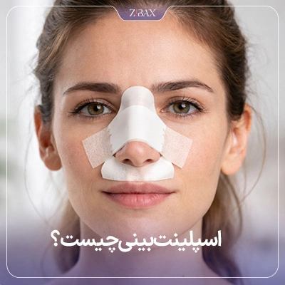 اسپلینت بینی چیست