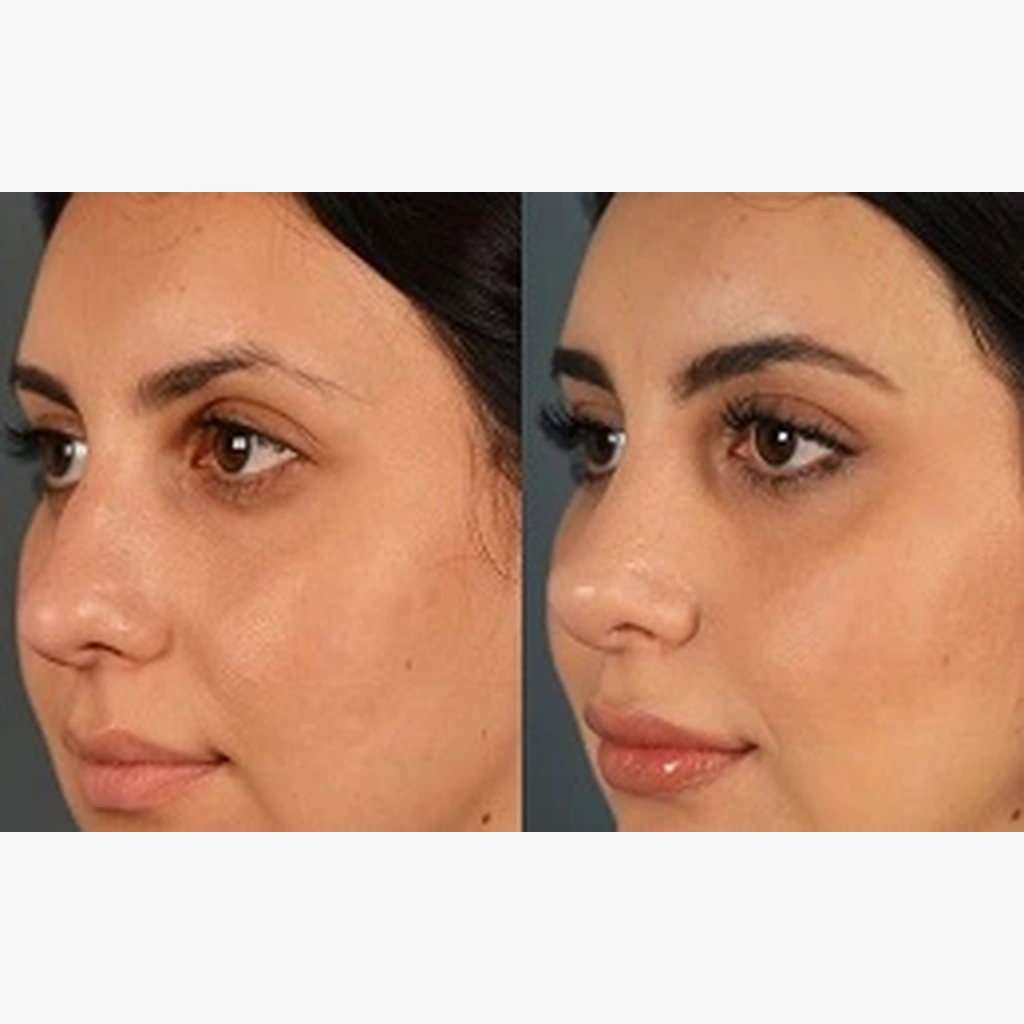 عکس بوتاکس بینی گوشتی