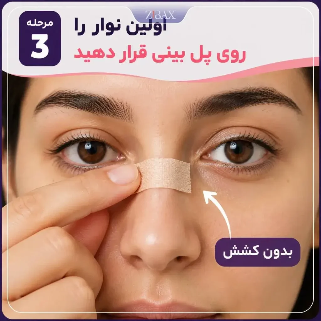 قرار دادن اولین نوار چسب روی پل بینی بعد از عمل