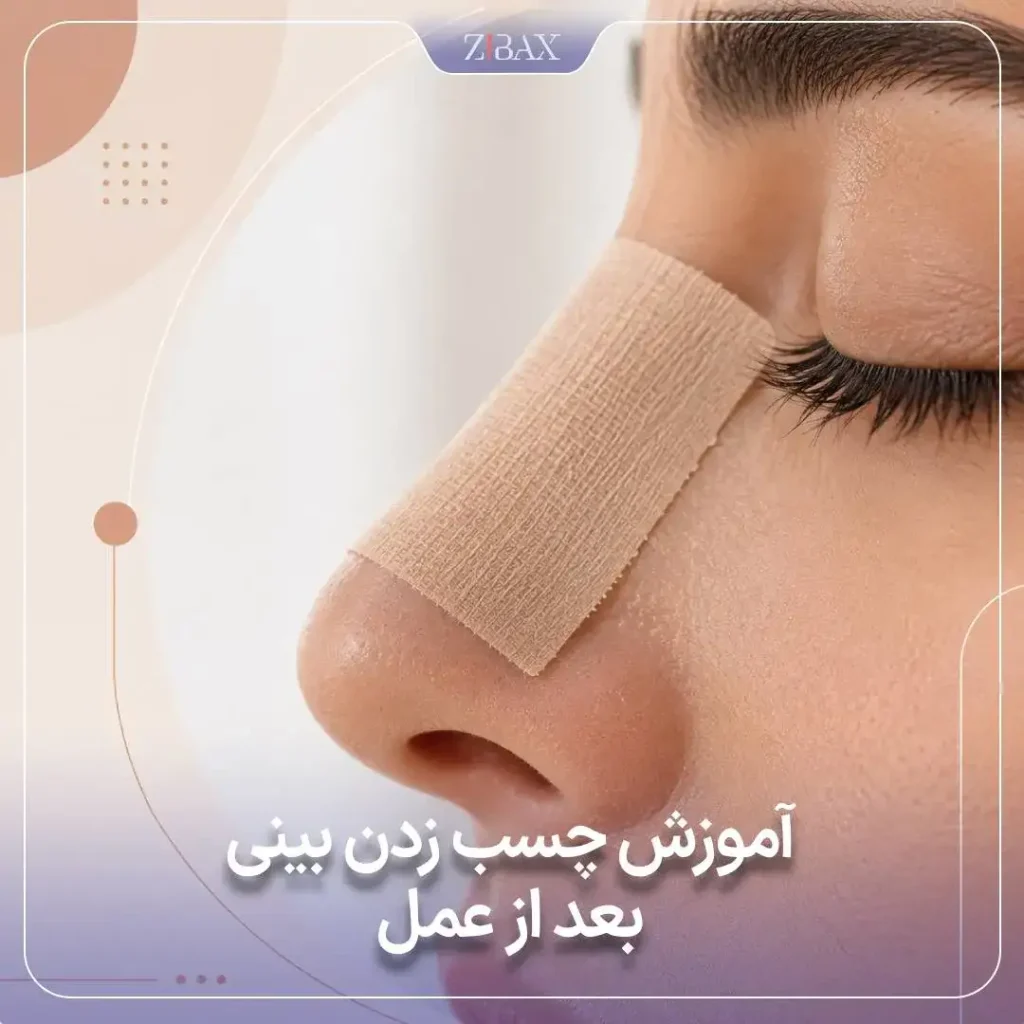 تصویری از نحوه صحیح قرار دادن چسب روی پل بینی بعد از عمل