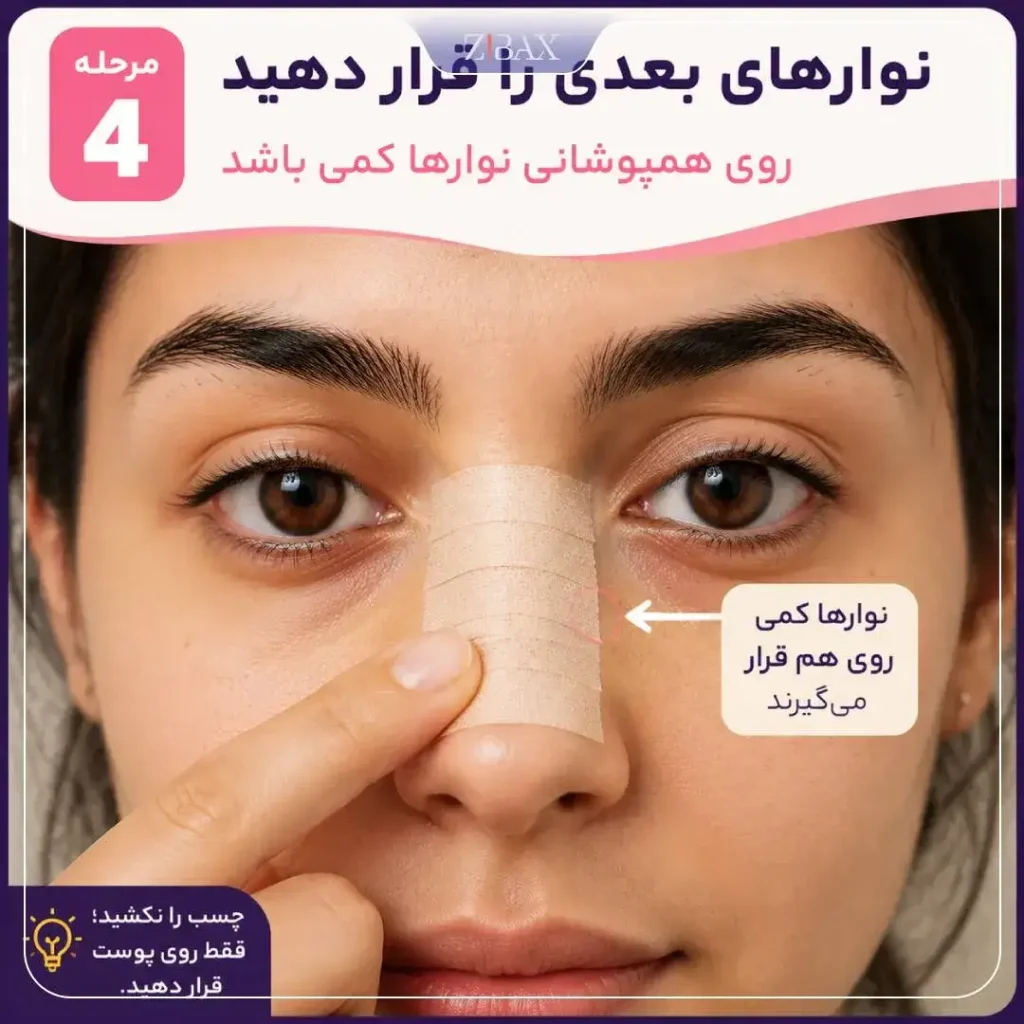 قرار گرفتن چند نوار چسب روی پل بینی با همپوشانی جزئی