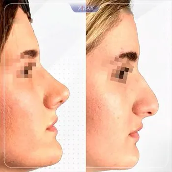 نمونه عمل جراحی بینی دکتر وحید عین آبادی — تصویر 4