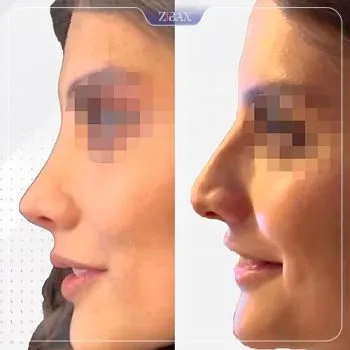 نمونه عمل جراحی بینی دکتر وحید عین آبادی — تصویر 3