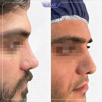 نمونه عمل جراحی بینی دکتر وحید عین آبادی — تصویر 7
