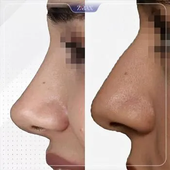 نمونه عمل جراحی بینی دکتر وحید عین آبادی — تصویر 8