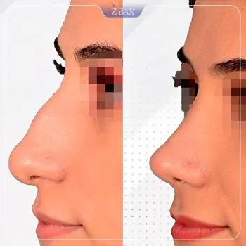 نمونه عمل جراحی بینی دکتر وحید عین آبادی — تصویر 9