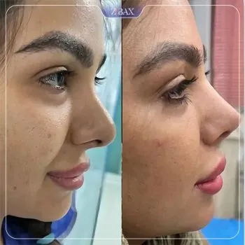 نمونه عمل جراحی بینی دکتر وحید عین آبادی — تصویر 10