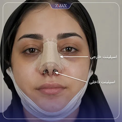 بررسی انواع اسپلینت بینی داخلی و خارجی
