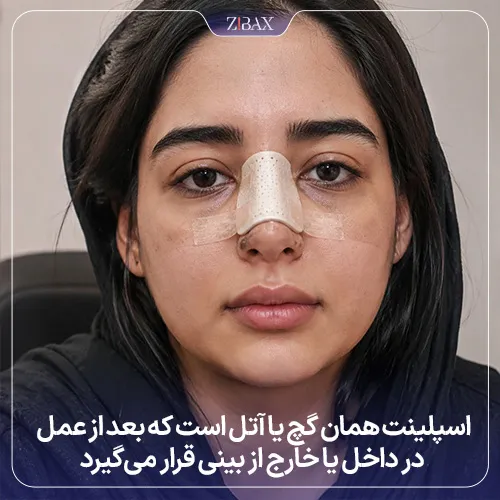 اسپلینت بینی چیست