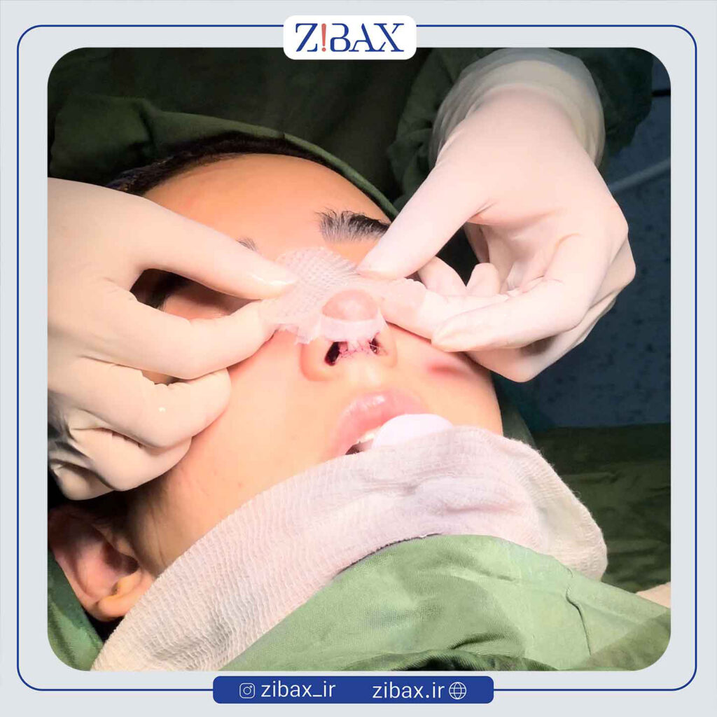 دلیل استفاده از اسپلینت بینی