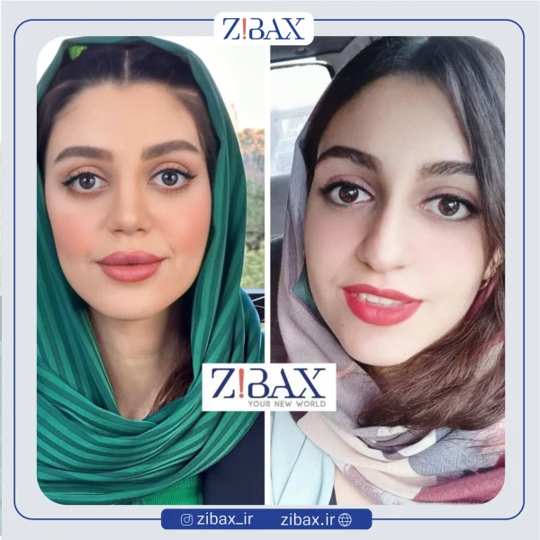 عکس قبل و بعد عمل بینی