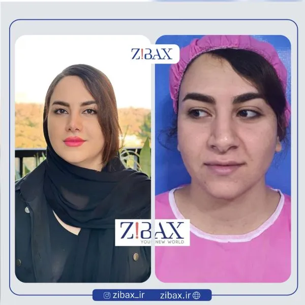 عکسش قبل و بعد رینوپلاستی