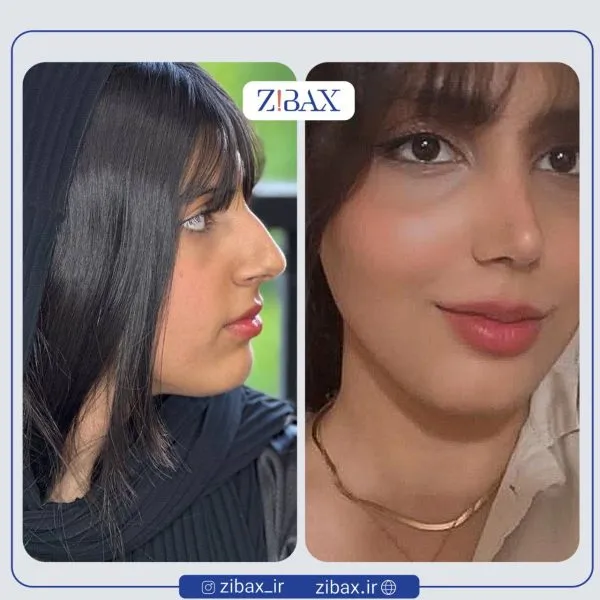 عمل بینی قبل و بعد