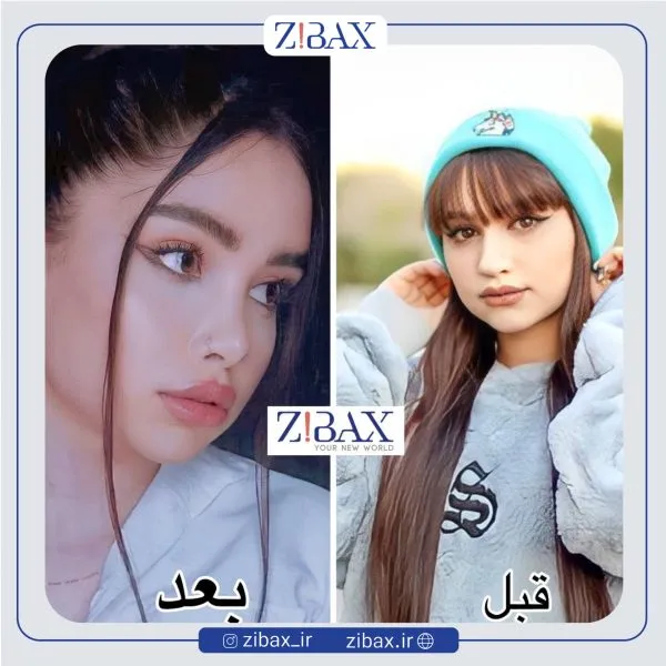 نمونه عمل بینی اینستا گرام زیباکس
