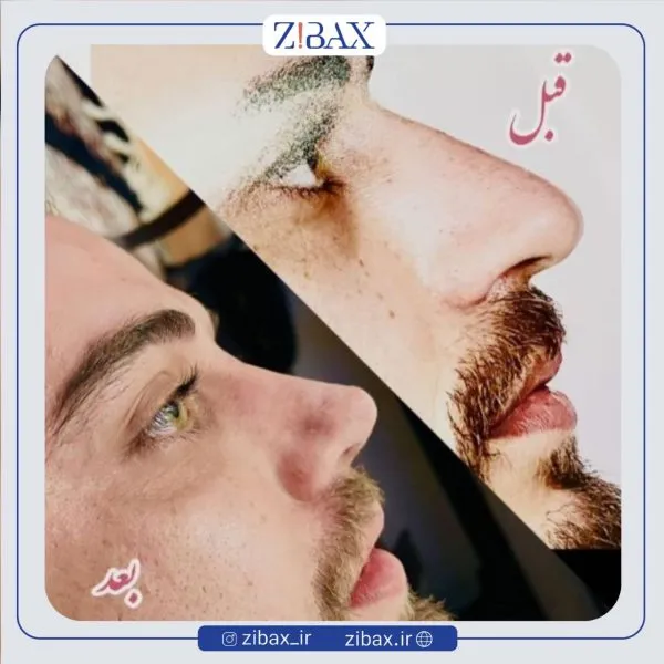 نمونه کار عمل بینی قبل و بعد