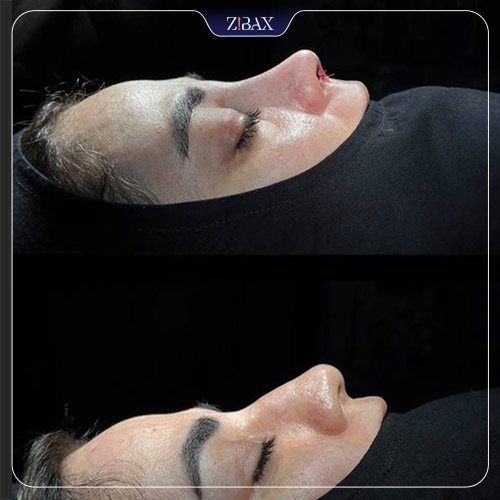 نمونه عمل جراحی بینی دکتر حمیدرضا کریمی — تصویر 1