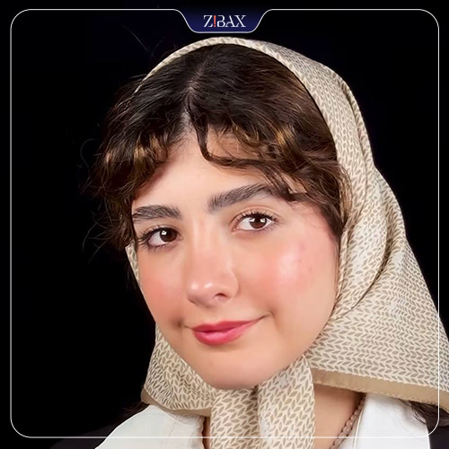 نمونه عمل جراحی بینی دکتر حمیدرضا کریمی — تصویر 5
