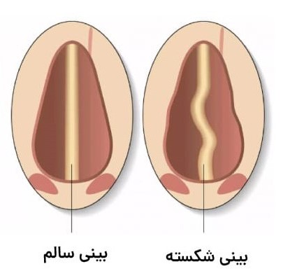 اقدامات ضروری بینی شکسته؛ مجموعه زیباکس